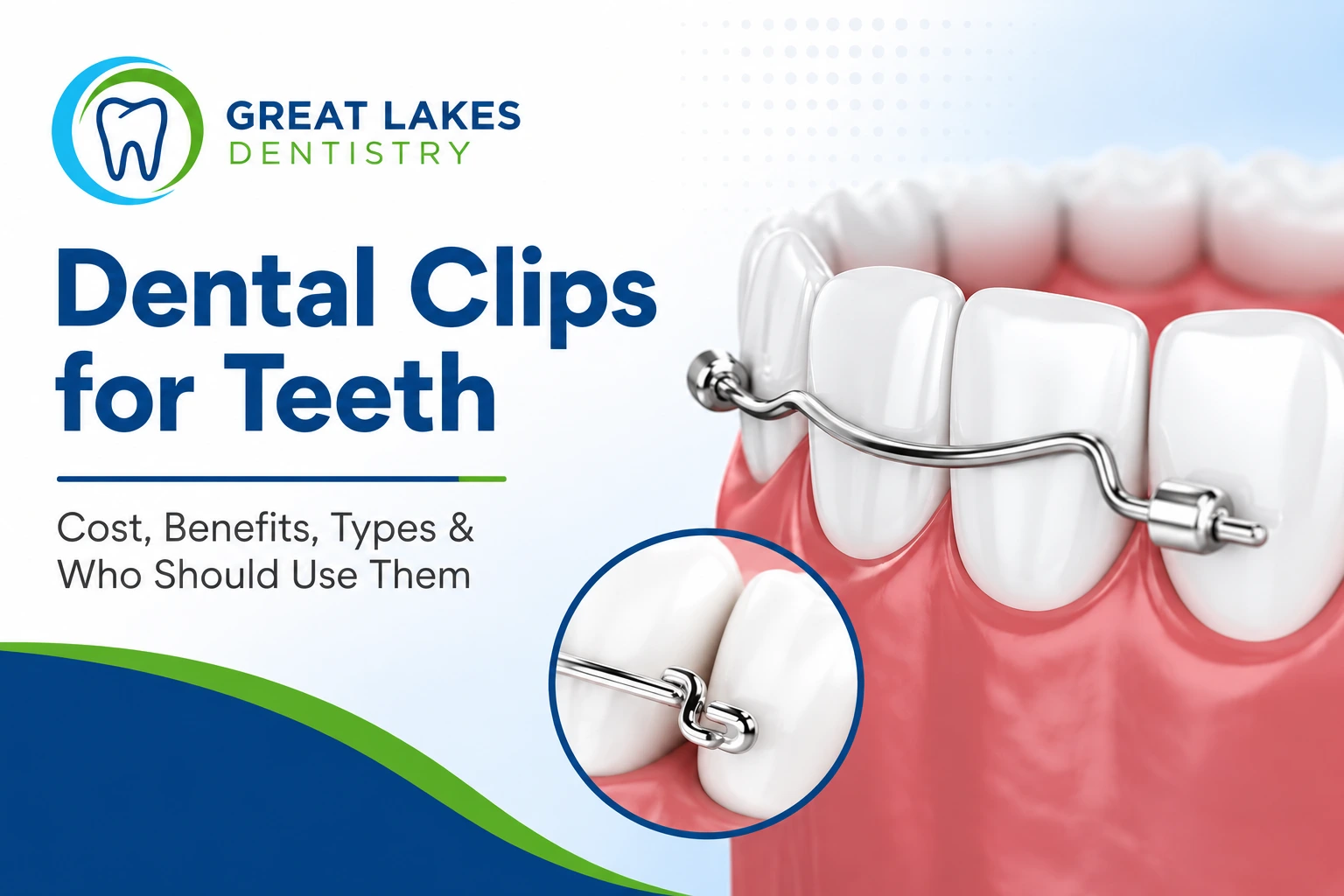 Dental clips for teeth cost benefits types and who should use them Great Lakes Dentistry Oakville