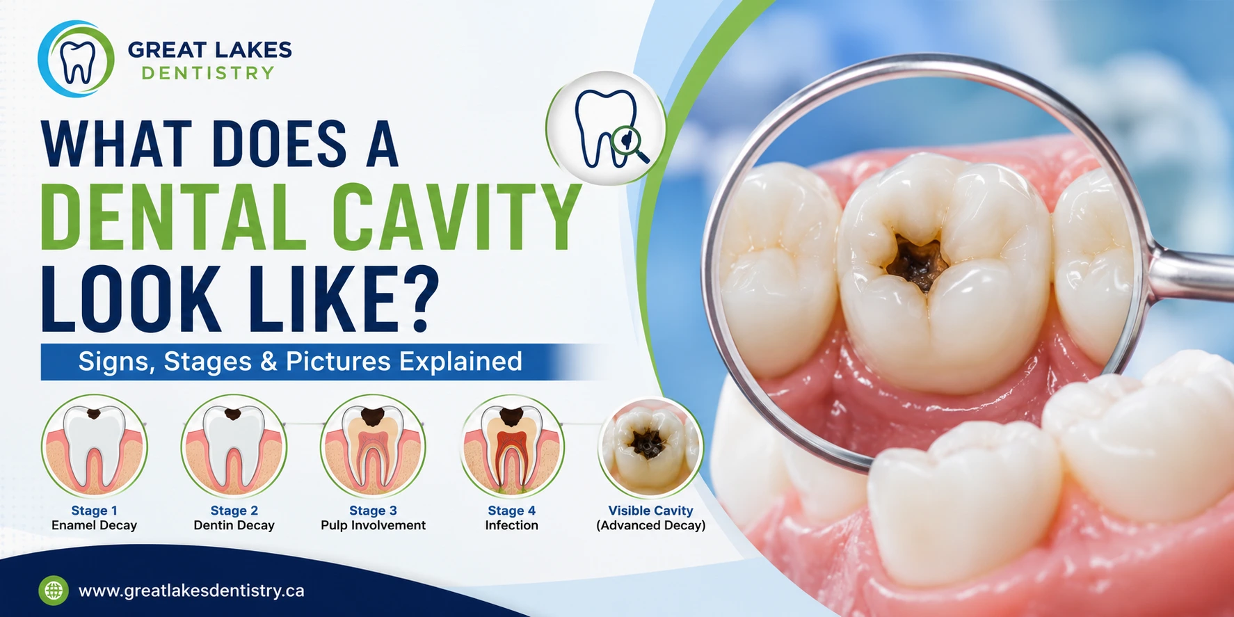 What does a dental cavity look like signs stages and pictures explained Great Lakes Dentistry Oakville